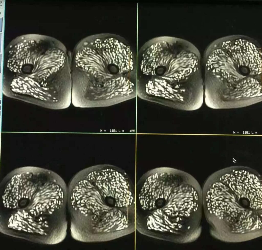 Young Woman s Body Brain Riddled With Parasitic Worms Cysts After young-woman-s-body-brain-riddled-with-parasitic-worms-cysts-after